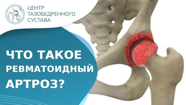 Ревматоидный артрит - что это за заболевание? Ревматоидный артрит что это. Доктор Ерёмин. 18+ Ревматоидный артрит - что это за заболевание? Ревматоидный артрит что это. Доктор Ерёмин. 18+