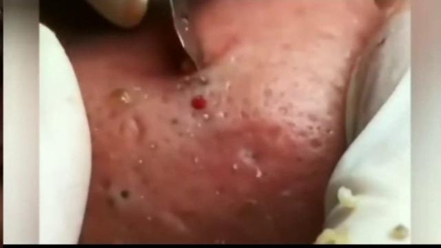 Blackheads Removal Full Video! Blackhead Extractions/ ЧИСТКА ЛИЦА Выдавливание Черных точек на лице Blackheads Removal Full Video! Blackhead Extractions/ ЧИСТКА ЛИЦА Выдавливание Черных точек на лице