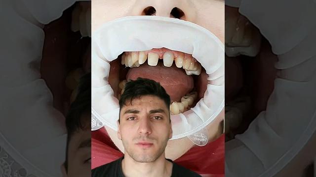 Как ставят виниры Как ставят виниры