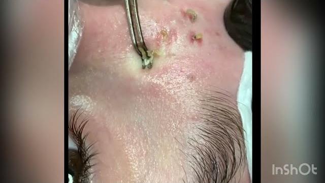 Big blackheads | Давим черные точки и прыщи Big blackheads | Давим черные точки и прыщи