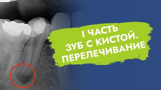 Зуб с кистой. Перелечивание. Зуб с кистой. Перелечивание.