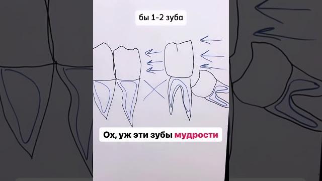 Болит зуб мудрости. Удалять зуб мудрости? Болит зуб мудрости. Удалять зуб мудрости?