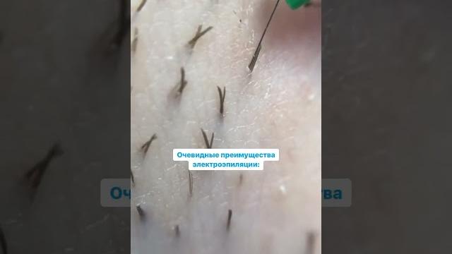 Очевидные преимущества электроэпиляции #ЭлектроэпиляцияБишкек #УдалениеВолосНавсегда Очевидные преимущества электроэпиляции #ЭлектроэпиляцияБишкек #УдалениеВолосНавсегда