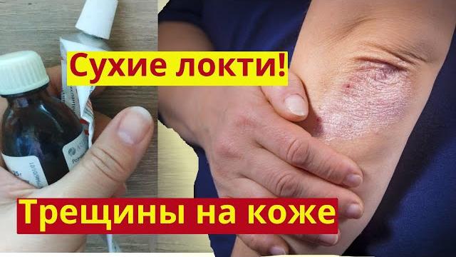 Сухие локти. Шершавые локти. Трескаются руки. Трескаются пятки. Заживляет и омолаживает. Рецепт мази Сухие локти. Шершавые локти. Трескаются руки. Трескаются пятки. Заживляет и омолаживает. Рецепт мази
