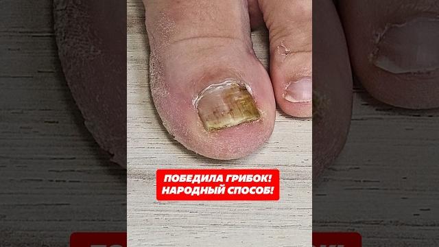 Победила грибок! Народный способ! #грибок #лечение #домохозяйка #ноги #уходовыесредства #ногти #дом Победила грибок! Народный способ! #грибок #лечение #домохозяйка #ноги #уходовыесредства #ногти #дом