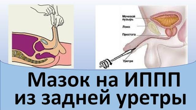 Мазок на ИППП из задней уретры Мазок на ИППП из задней уретры