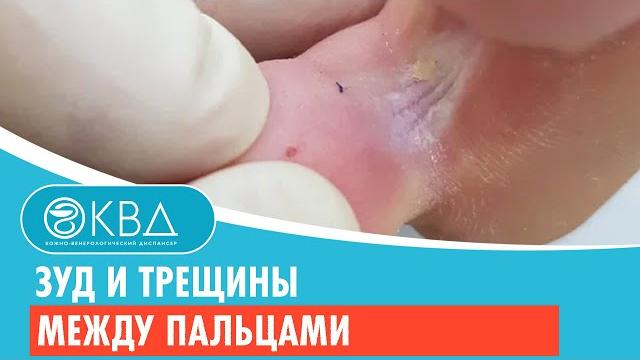 Зуд и трещины между пальцами. Клинический случай №374 Зуд и трещины между пальцами. Клинический случай №374