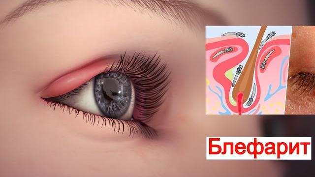 Блефарит (Воспаление Век). Симптомы и Лечение Блефарит (Воспаление Век). Симптомы и Лечение