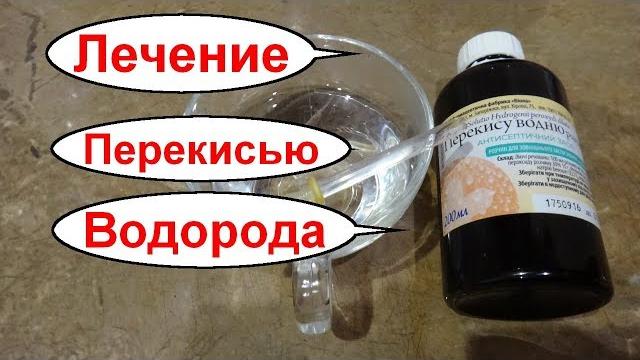 Лечение гастрита и язвы желудка перекисью водорода Как принимать перекись водорода внутрь Неумывакин Лечение гастрита и язвы желудка перекисью водорода Как принимать перекись водорода внутрь Неумывакин