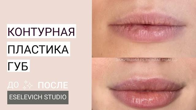 Контурная пластика губ. Какой объем гиалуроновой кислоты лучше колоть в губы? Препарат Juvederm Контурная пластика губ. Какой объем гиалуроновой кислоты лучше колоть в губы? Препарат Juvederm