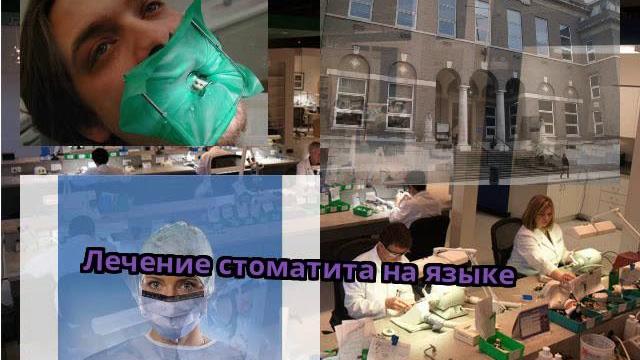 Лечение стоматита на языке Лечение стоматита на языке