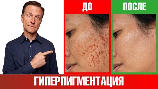 Как избавиться от пигментации любого происхождения? Как избавиться от пигментации любого происхождения?