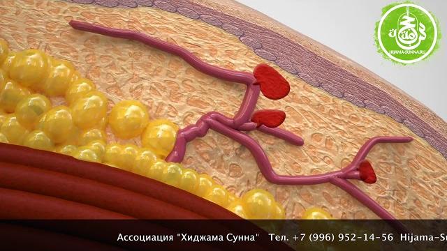 Как воздействует Хиджама на организм? 2d видео Как воздействует Хиджама на организм? 2d видео