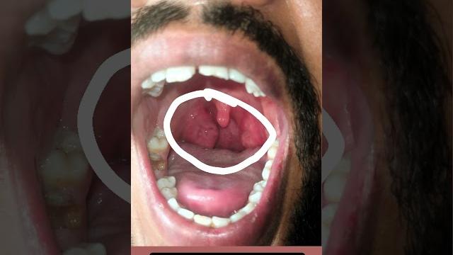 #tonsilitis #shorts #infection #tonsilitis #shorts #infection