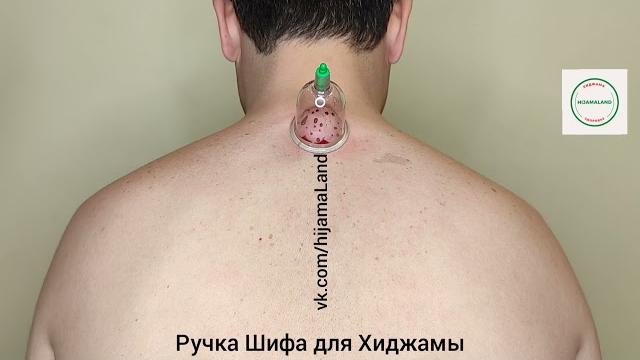 Главные точки Хиджамы, ручкой Шифа! Главные точки Хиджамы, ручкой Шифа!