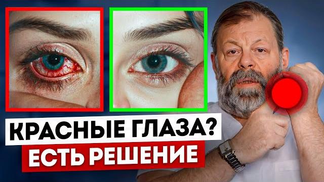 Красные глазаI Почему краснеют глаза? Покраснел 1 глаз, сосуды в глазах - что делать. Узнай причины Красные глазаI Почему краснеют глаза? Покраснел 1 глаз, сосуды в глазах - что делать. Узнай причины