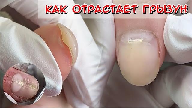 How does a rodent grow back? I bite my nails, what should I do? Picking nails how to fix? How does a rodent grow back? I bite my nails, what should I do? Picking nails how to fix?