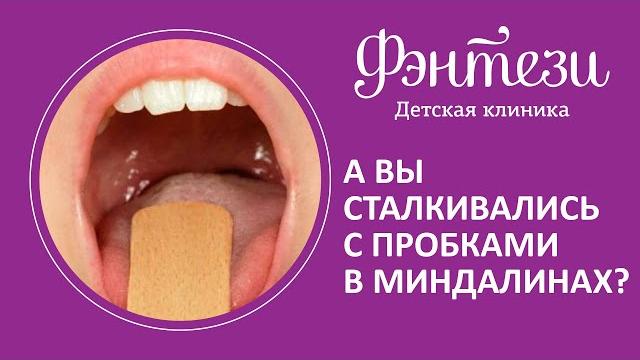 А вы сталкивались с пробками в миндалинах?Отоларинголог Некрасова Наталия #детскаяклиникамосква А вы сталкивались с пробками в миндалинах?Отоларинголог Некрасова Наталия #детскаяклиникамосква