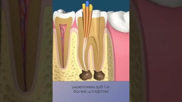 Как проходит лечение корневых каналов? Как проходит лечение корневых каналов?