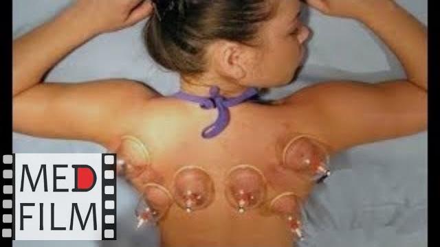 Как правильно ставить банки © Cupping therapy Как правильно ставить банки © Cupping therapy