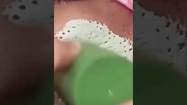 Лайфхак как избавиться от прыщей раз и навсегда Лайфхак как избавиться от прыщей раз и навсегда