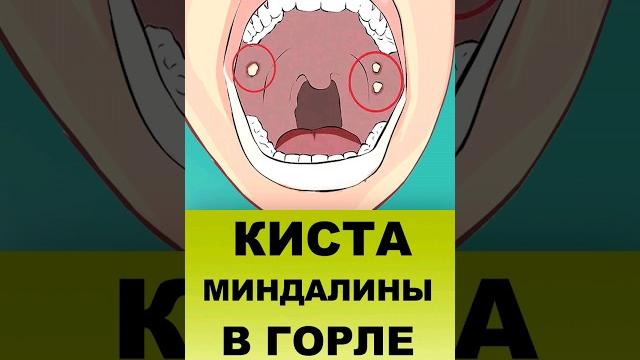 КИСТА МИНДАЛИНЫ В ГОРЛЕ КИСТА МИНДАЛИНЫ В ГОРЛЕ