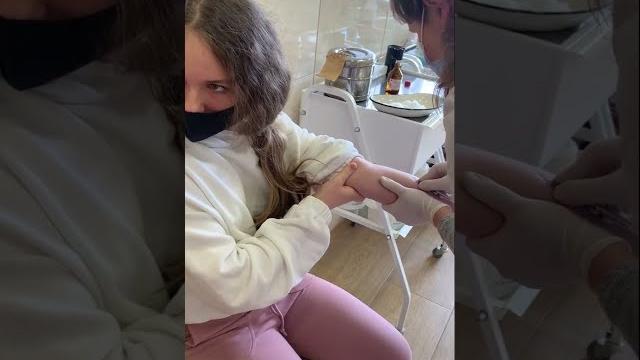 Как делают прививку манту Как делают прививку манту
