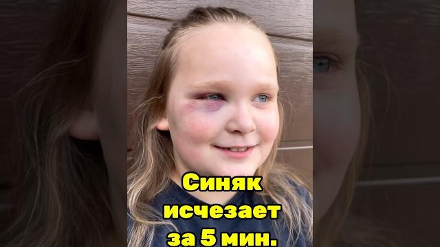 Как избавиться от любого синяка за 5 минут Как избавиться от любого синяка за 5 минут