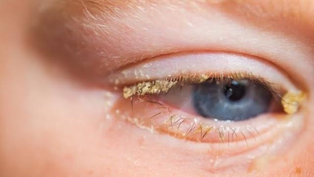 Как лечить конъюнктивит Как лечить конъюнктивит