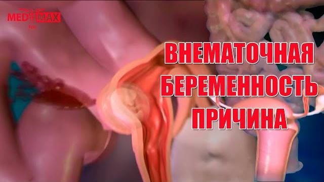 Внематочная беременность. Как происходит? #беременность #внематочнаябеременность #женскоездоровье Внематочная беременность. Как происходит? #беременность #внематочнаябеременность #женскоездоровье