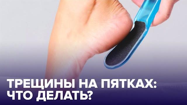 Почему ТРЕСКАЮТСЯ ПЯТКИ? Правила ухода за ногами Почему ТРЕСКАЮТСЯ ПЯТКИ? Правила ухода за ногами