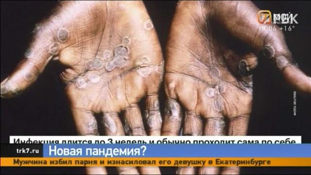По миру расползается обезьянья оспа По миру расползается обезьянья оспа