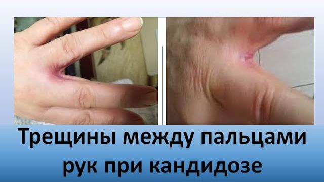 Трещины между пальцами рук при кандидозе Трещины между пальцами рук при кандидозе
