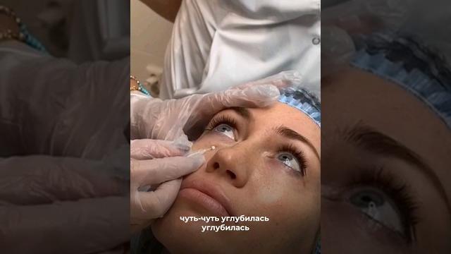 Мезонити в глаза от морщин Мезонити в глаза от морщин