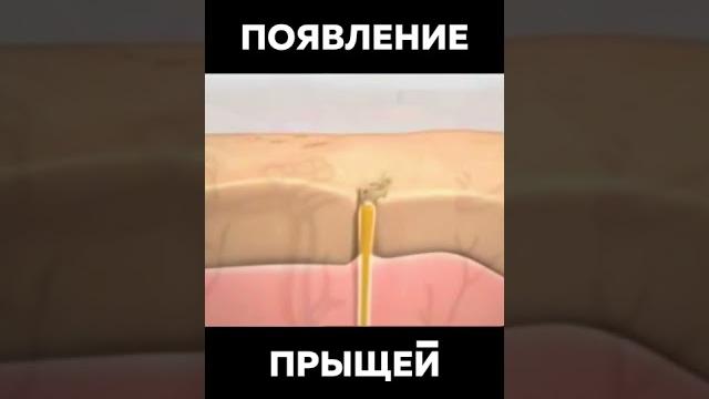 Как Появляются Прыщи #Шок #Ого #Прыщи Появление Прыщей На Лице у Человека Как Избавиться ??? Как Появляются Прыщи #Шок #Ого #Прыщи Появление Прыщей На Лице у Человека Как Избавиться ???