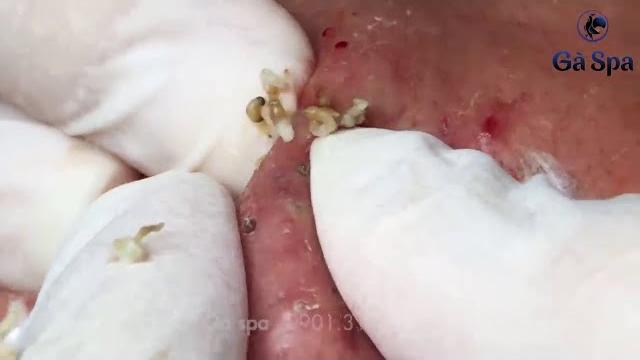 Чистка лица. Прыщи, угри и чёрные точки. Face cleaning. Pimples, blackheads, and black dots. Чистка лица. Прыщи, угри и чёрные точки. Face cleaning. Pimples, blackheads, and black dots.