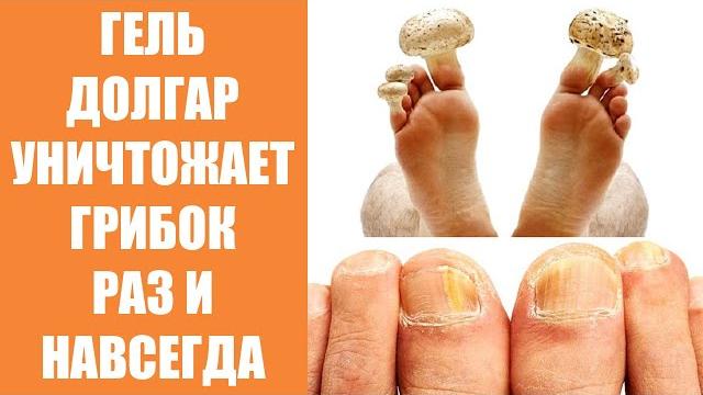 Что убивает грибок ногтей Что убивает грибок ногтей