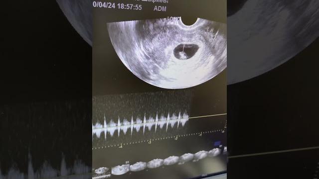 Сердцебиение в 7 недель ️ Сердцебиение в 7 недель ️