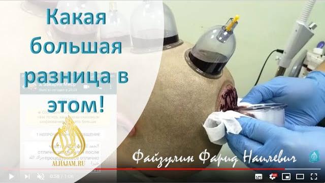 Хиджама на голову и спину Разница حجامة Хиджама на голову и спину Разница حجامة