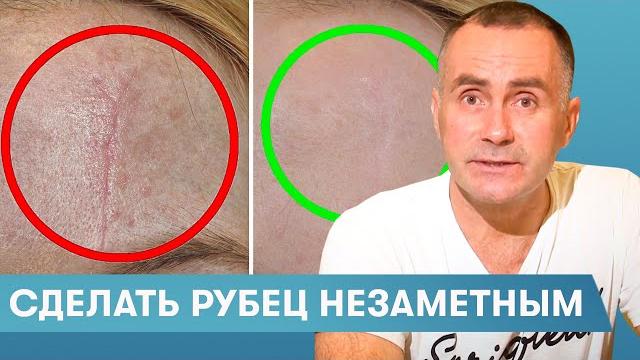 Как избавиться от рубцов на лице (шрамы, акне, послеоперационные) Хирург Караванов Дмитрий Как избавиться от рубцов на лице (шрамы, акне, послеоперационные) Хирург Караванов Дмитрий