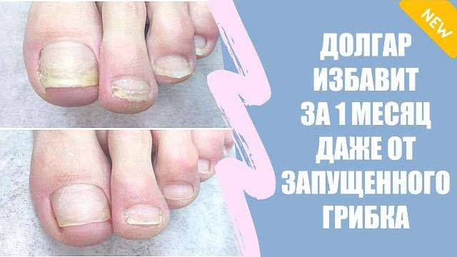 Грибок на коже лечение Грибок на коже лечение