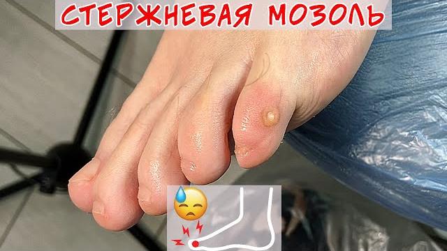 Removal of callus on the little toe Removal of callus on the little toe