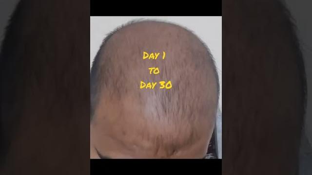 Neo Hair Lotion 30 days Result | Neo Hair Lotion Result Day 1 to Day 30 | How to use neo hair lotion Neo Hair Lotion 30 days Result | Neo Hair Lotion Result Day 1 to Day 30 | How to use neo hair lotion