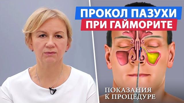 В каком случае прокалывают пазухи носа? / Гайморит В каком случае прокалывают пазухи носа? / Гайморит
