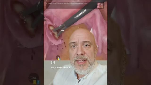 Как выглядит внематочная беременность Как выглядит внематочная беременность