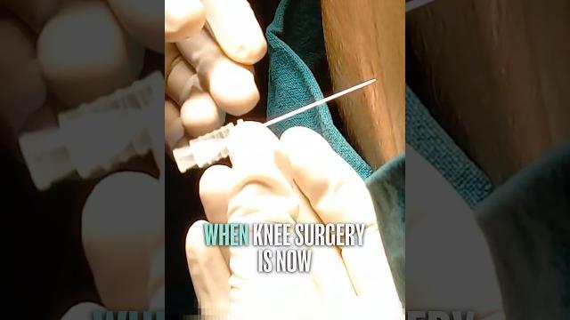 SpinE Injection Nerve Block #shorts SpinE Injection Nerve Block #shorts