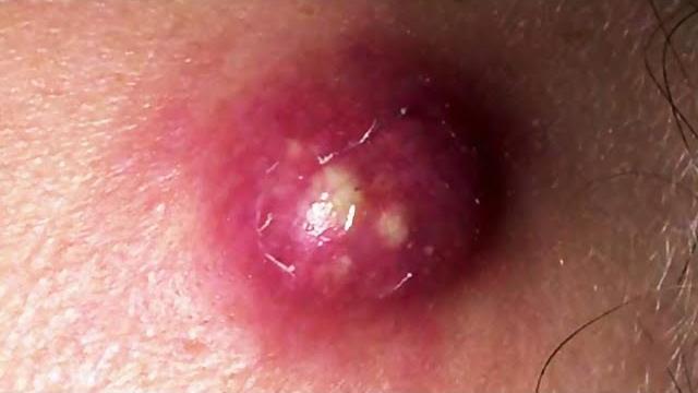 Выдавливание прыщей/акне/жировиков. Часть 4 | Squeezing out pimples / acne / wen. Part 4 Выдавливание прыщей/акне/жировиков. Часть 4 | Squeezing out pimples / acne / wen. Part 4