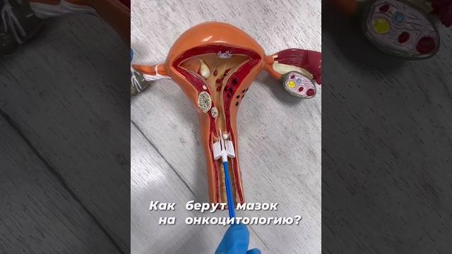 Как берут мазок на онкоцитологию Как берут мазок на онкоцитологию