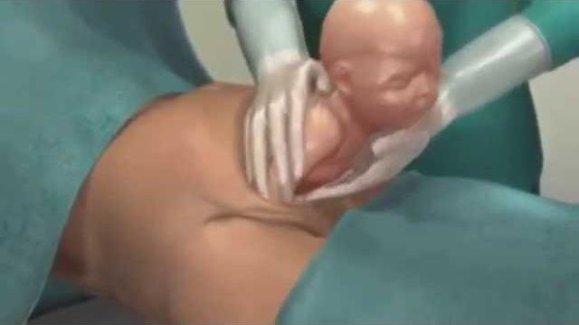 Кесарево сечение 3D Кесарево сечение 3D