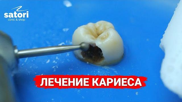 caries treatment caries treatment